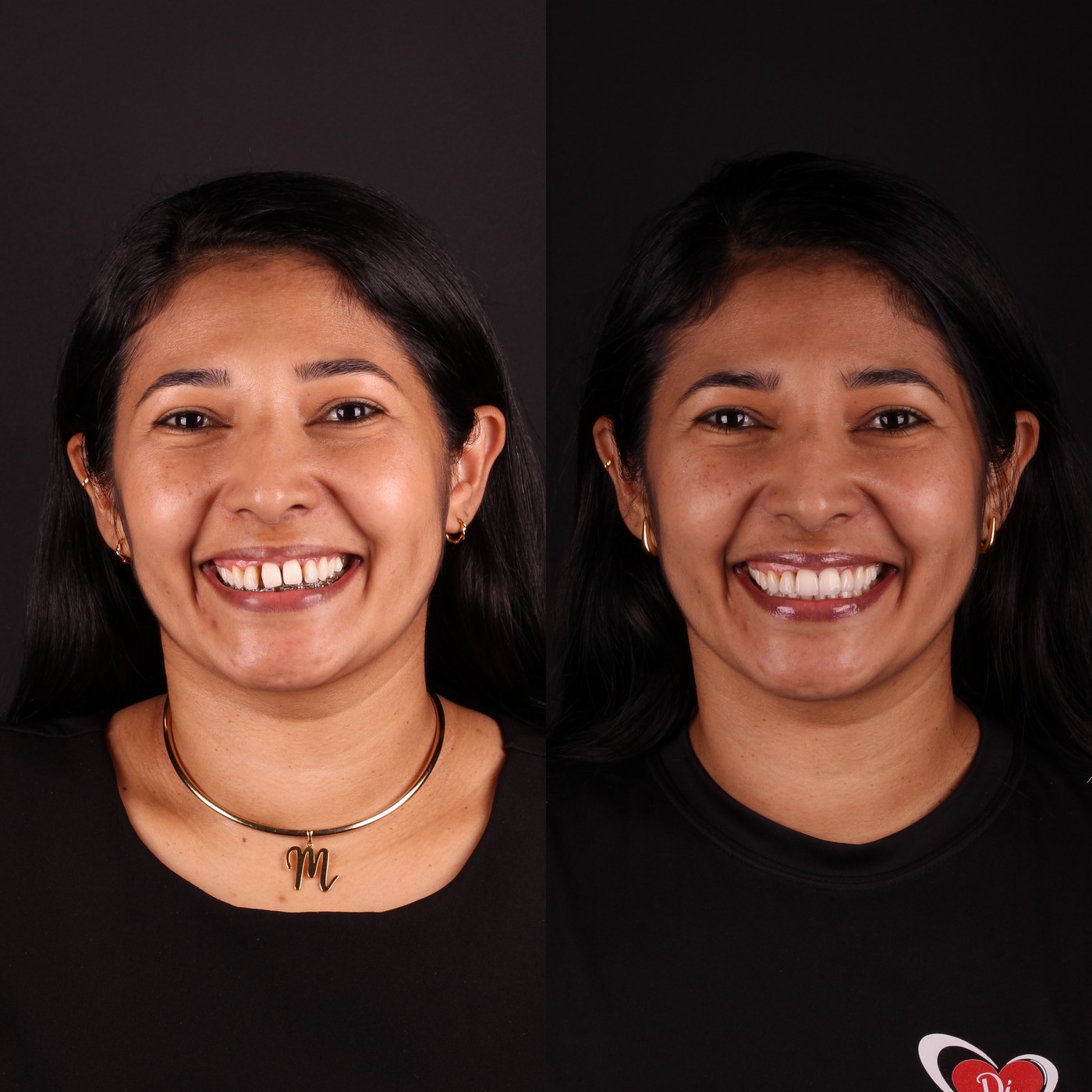 Antes e depois — Lentes de Resina, Clínica Reabilitar