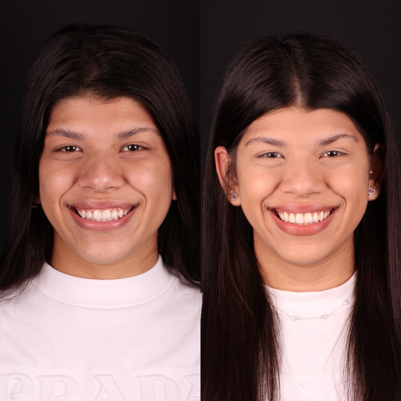 Antes e depois — Lentes de Resina, Clínica Reabilitar